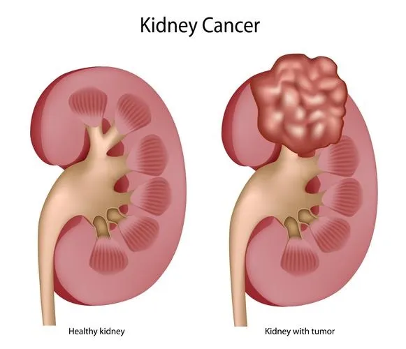 Kidney Cancer: कारण, लक्षण और निदान जाने । Kidney Cancer: कारण, लक्षण और निदान जाने ।