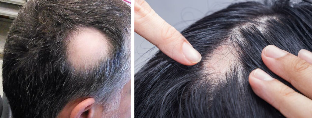 Alopecia:कारण, लक्षण, निदान और तथ्य के बारे में जानिये