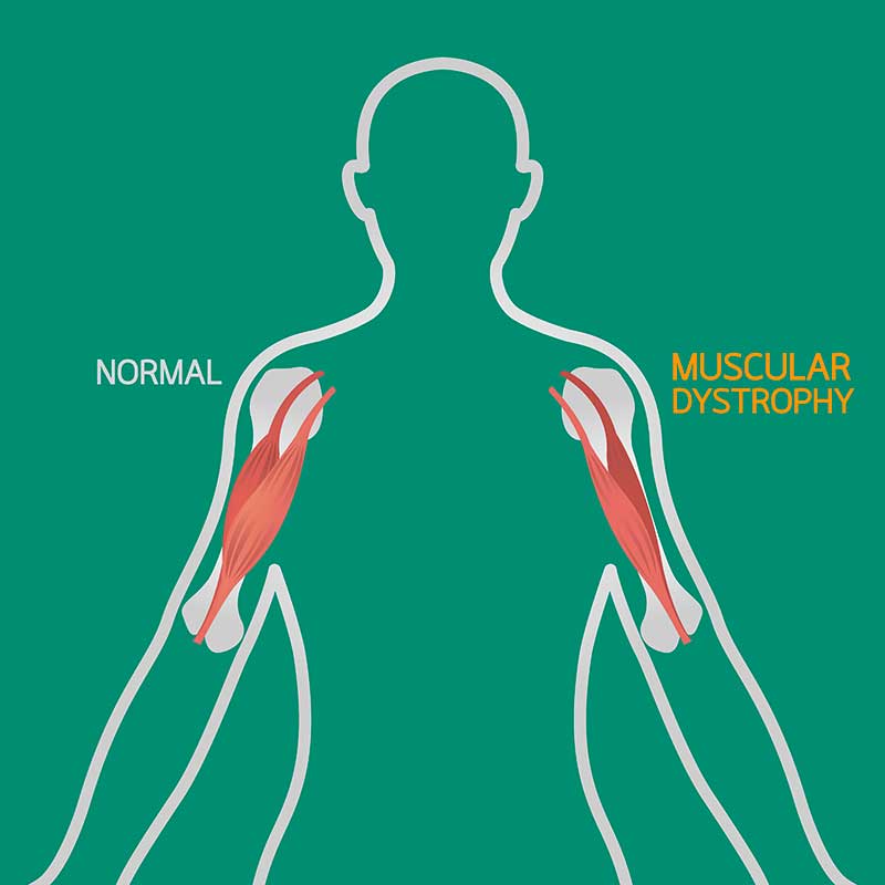 Muscular Dystrophy: आयुर्वेद के माध्यम से मिलेगा आराम