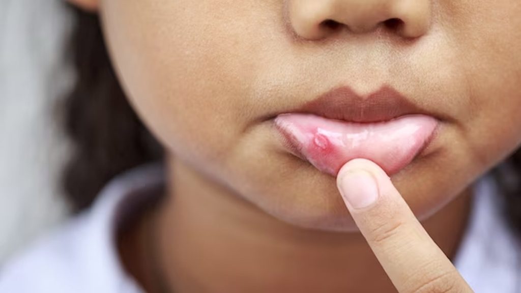 Mouth Ulcers: मुंह में छाले अक्सर होते हैं? मुंह में बार-बार छाले होने से कौन-सी स्वास्थ्य समस्याएं हो सकती हैं? आइए जानते हैं। Mouth Ulcers: मुंह में छाले अक्सर होते हैं? मुंह में बार-बार छाले होने से कौन-सी स्वास्थ्य समस्याएं हो सकती हैं? आइए जानते हैं।