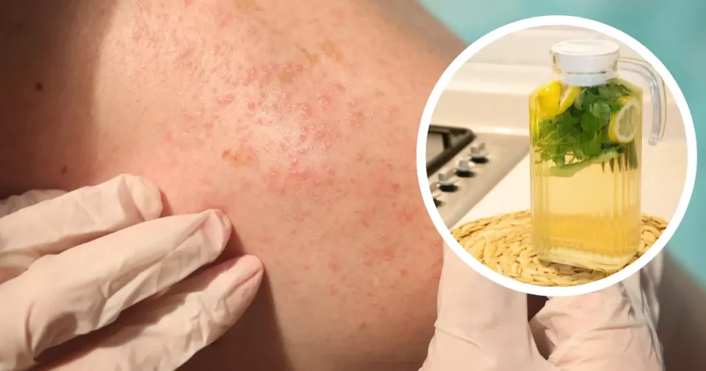 Home Remedies For Heat Rash: चिपचिपी गर्मी में घमौरियों से परेशान? ये 10 देसी नुस्खे दिलाएंगे तुरंत राहत