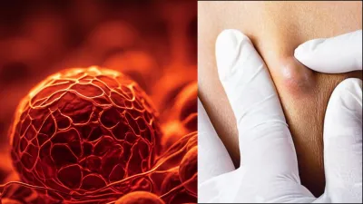 तेजी से बढ़ती गांठ हो सकती है कैंसर का शुरुआती संकेत, जानें लक्षण और इलाज तेजी से बढ़ती गांठ हो सकती है कैंसर का शुरुआती संकेत, जानें लक्षण और इलाज