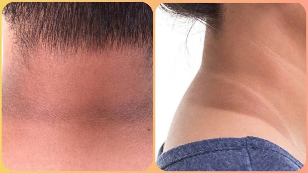 Dark Circles on Neck: क्या आपकी गर्दन पर भी आ गए हैं काले घेरे ? करें घरेलू उपाय