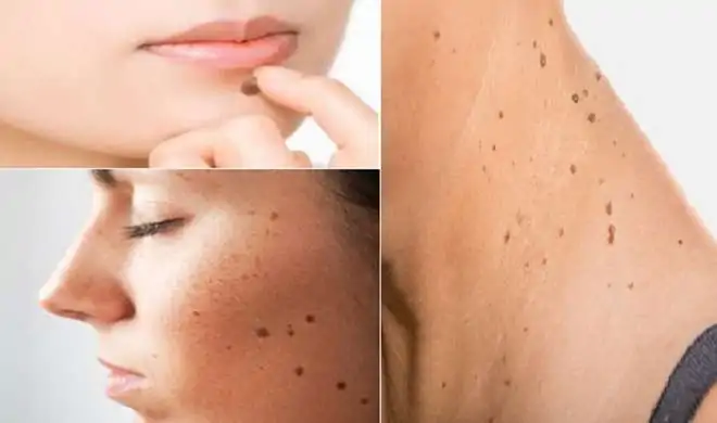 Lime for Mole: चेहरे के जिद्दी तिल को दूर करने के लिए चेहरे पर लगाएं चूना, कुछ ही दिनों में परिणाम दिखेगा