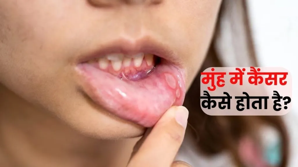 Mouth Ulcer Cancer Symptoms: मुंह के छाले और कैंसर के लक्षण, कब हो जाएं सतर्क? जानें जरूरी संकेत और बचाव के उपाय